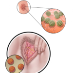 genital warts genital warts
