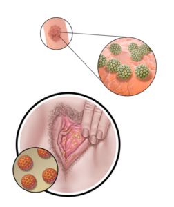 hpv infection genital warts)