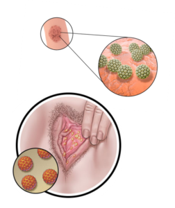 Hpv related warts